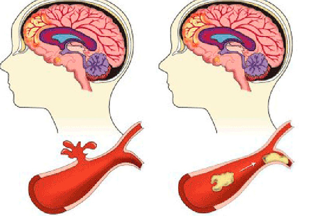 Ischemic stroke. Ишемический и геморрагический инсульт. Инсульт рисунок.