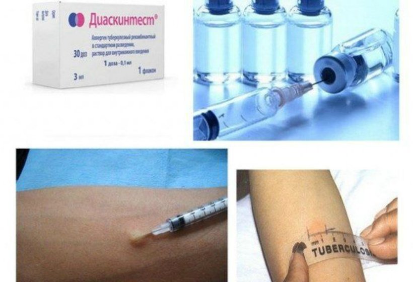 Отказ от прививок против туберкулеза thumbnail