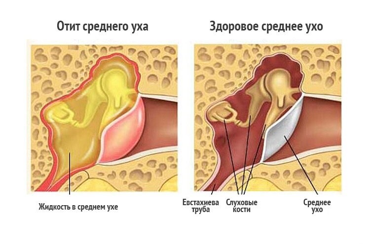 боль в ухе при коронавирусе чем лечить. Смотреть фото боль в ухе при коронавирусе чем лечить. Смотреть картинку боль в ухе при коронавирусе чем лечить. Картинка про боль в ухе при коронавирусе чем лечить. Фото боль в ухе при коронавирусе чем лечить