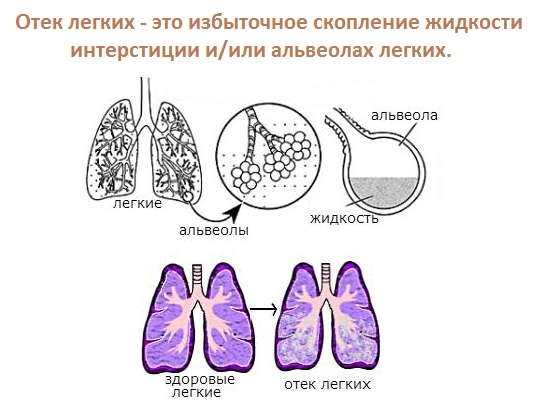 Отек легких презентация