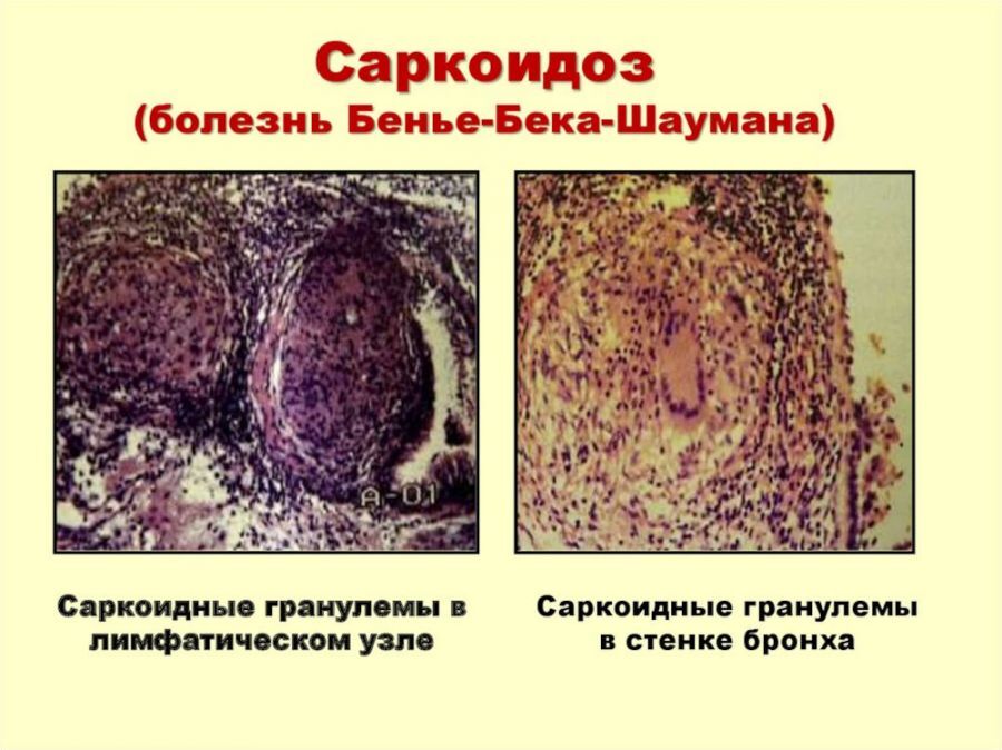 Саркоидоз легких: лечение, симптомы, диагностика