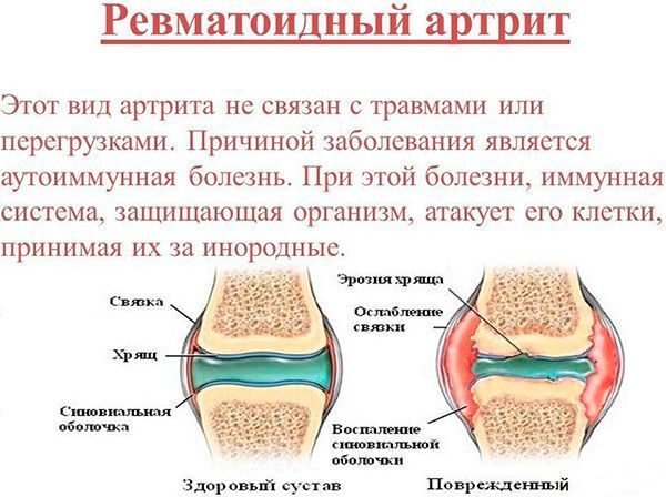 болят мышцы ног после коронавируса что делать лечение. Смотреть фото болят мышцы ног после коронавируса что делать лечение. Смотреть картинку болят мышцы ног после коронавируса что делать лечение. Картинка про болят мышцы ног после коронавируса что делать лечение. Фото болят мышцы ног после коронавируса что делать лечение