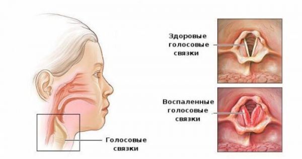 голос стал сиплым после коронавируса чем лечить. Смотреть фото голос стал сиплым после коронавируса чем лечить. Смотреть картинку голос стал сиплым после коронавируса чем лечить. Картинка про голос стал сиплым после коронавируса чем лечить. Фото голос стал сиплым после коронавируса чем лечить