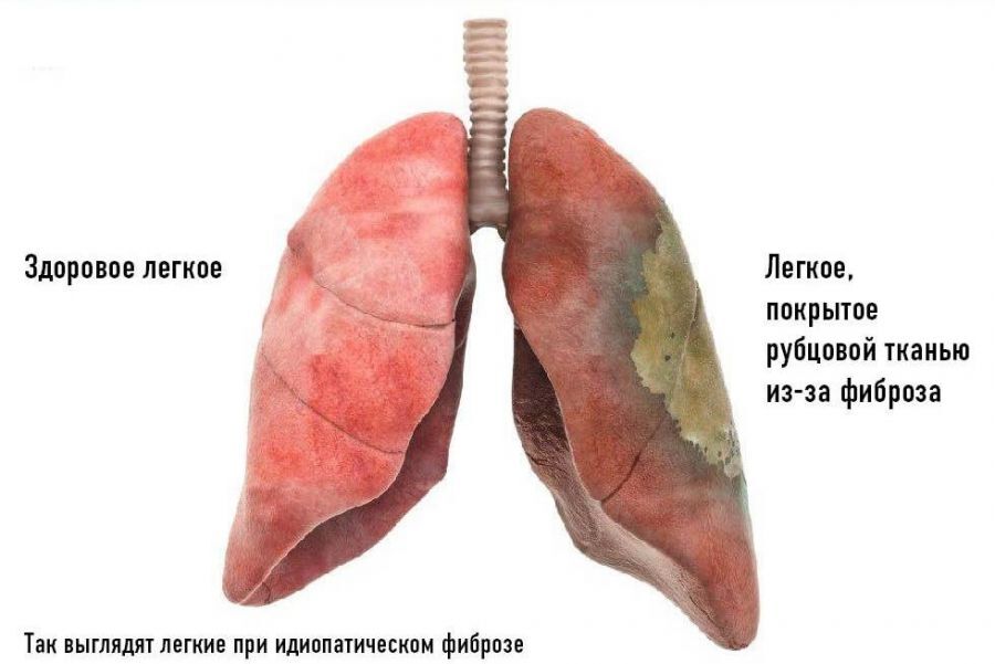 через какое время проходит отдышка после коронавируса. Смотреть фото через какое время проходит отдышка после коронавируса. Смотреть картинку через какое время проходит отдышка после коронавируса. Картинка про через какое время проходит отдышка после коронавируса. Фото через какое время проходит отдышка после коронавируса