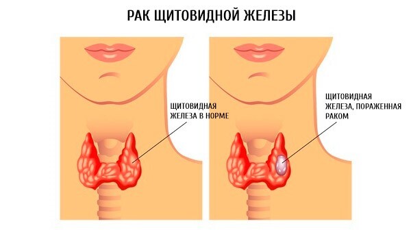 Как избавиться от ощущения кома в горле?