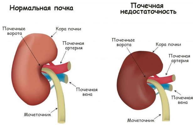 заболела почка при коронавирусе что делать. Смотреть фото заболела почка при коронавирусе что делать. Смотреть картинку заболела почка при коронавирусе что делать. Картинка про заболела почка при коронавирусе что делать. Фото заболела почка при коронавирусе что делать