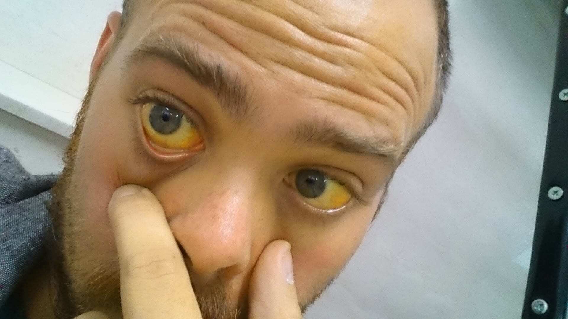 Почему глаза желтоватого