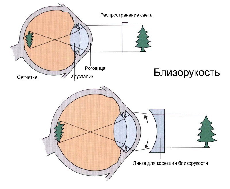 Формирование изображения при близорукости