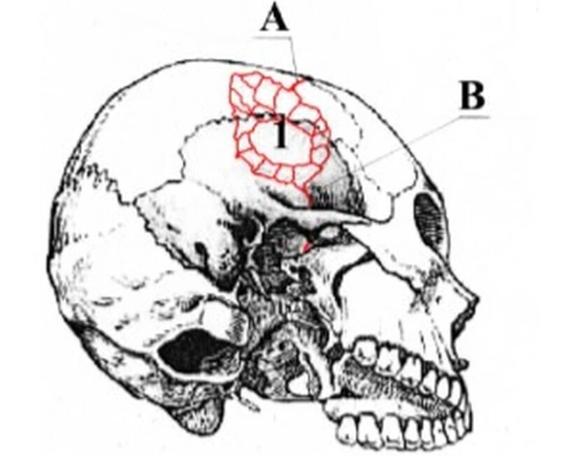 толщина черепной кости. перелом теменной кости на кт. оскольчатый перелом лобной кости. поперечный перелом височной кости кт. кости черепа височная кость.