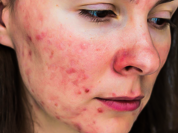 Розацеа – как ухаживать за кожей?