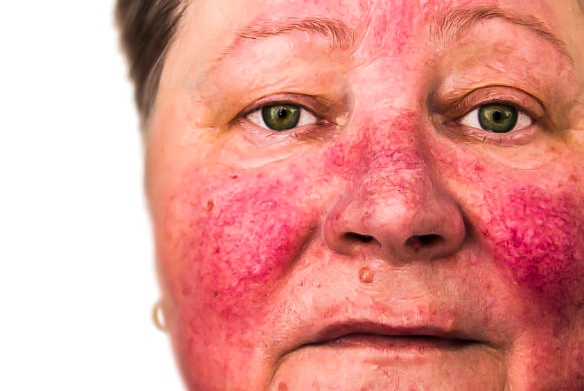 Розацеа – как ухаживать за кожей?