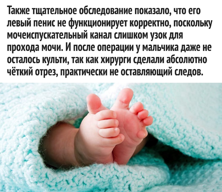 Редкая патология у мальчиков: один случай на 5 миллионов