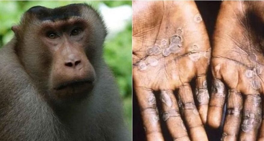 Оспа обезьян захватила новые страны: более 90 случаев заражения