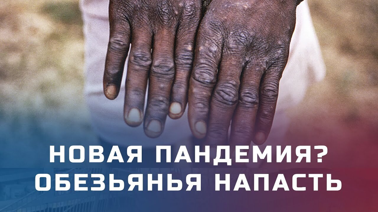 Новый вирус. Оспа обезьян - связь с ЛГБТ<span style=