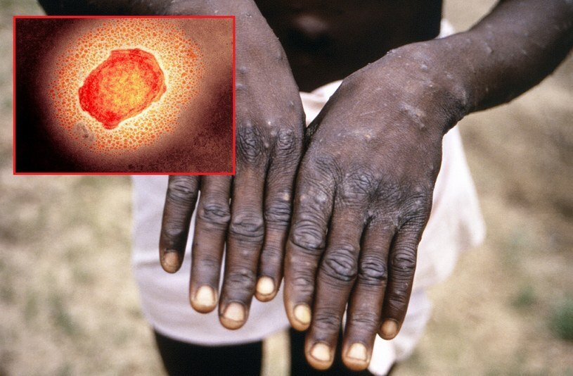 Оспа обезьян: каковы симптомы? Актуальный список стран, где выявлено заболевание