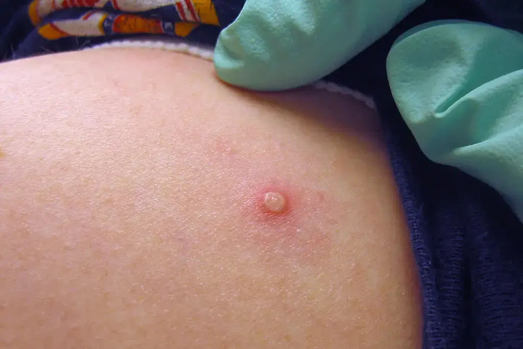 21 американец, зараженный оспой обезьян, сообщает C.D.C.