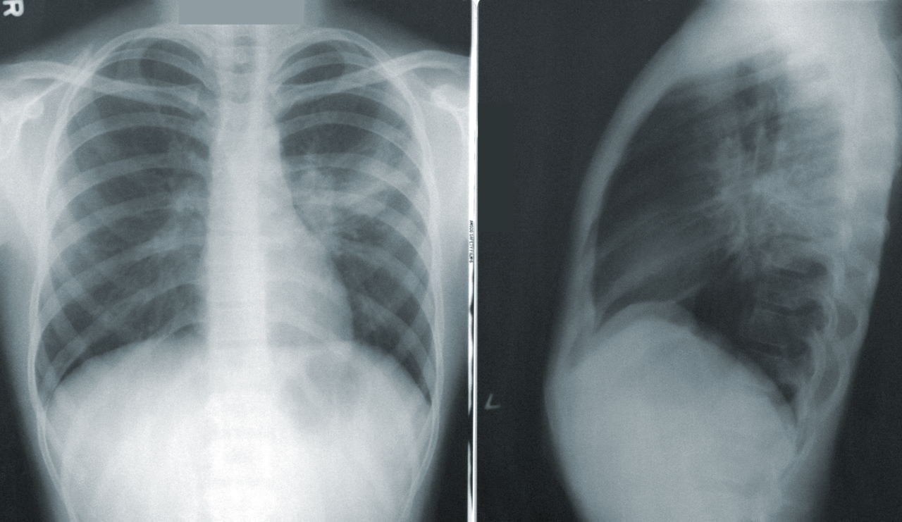 Наносенсоры помогли отличить бактериальную пневмонию от вирусной