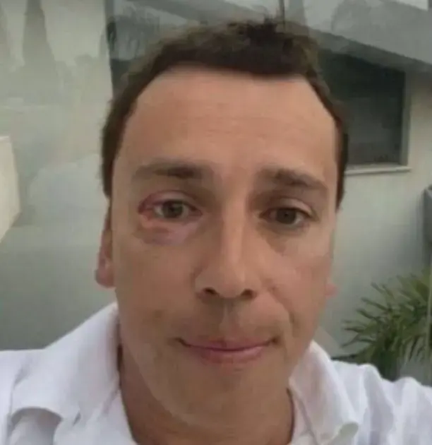 Первый синяк Алкина в Израиле.