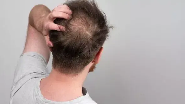 Рак: мужчины, которые начинают терять волосы в 20 лет, могут ли подвергаться более высокому риску заболеть онкологией