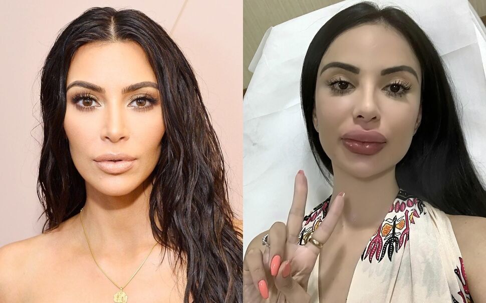 20 операций и 50 миллионов рублей, чтобы распухнуть до состояния Кардашьян. Модель разочаровалась в пластике