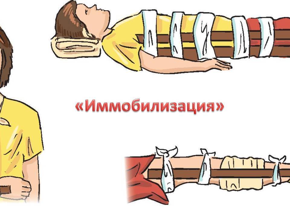 Задачи иммобилизации. Иммобилизация конечности при переломе. Транспортная иммобилизация при переломах. Иммобилизация травмированной конечности. Иммобилизация поврежденной части тела.