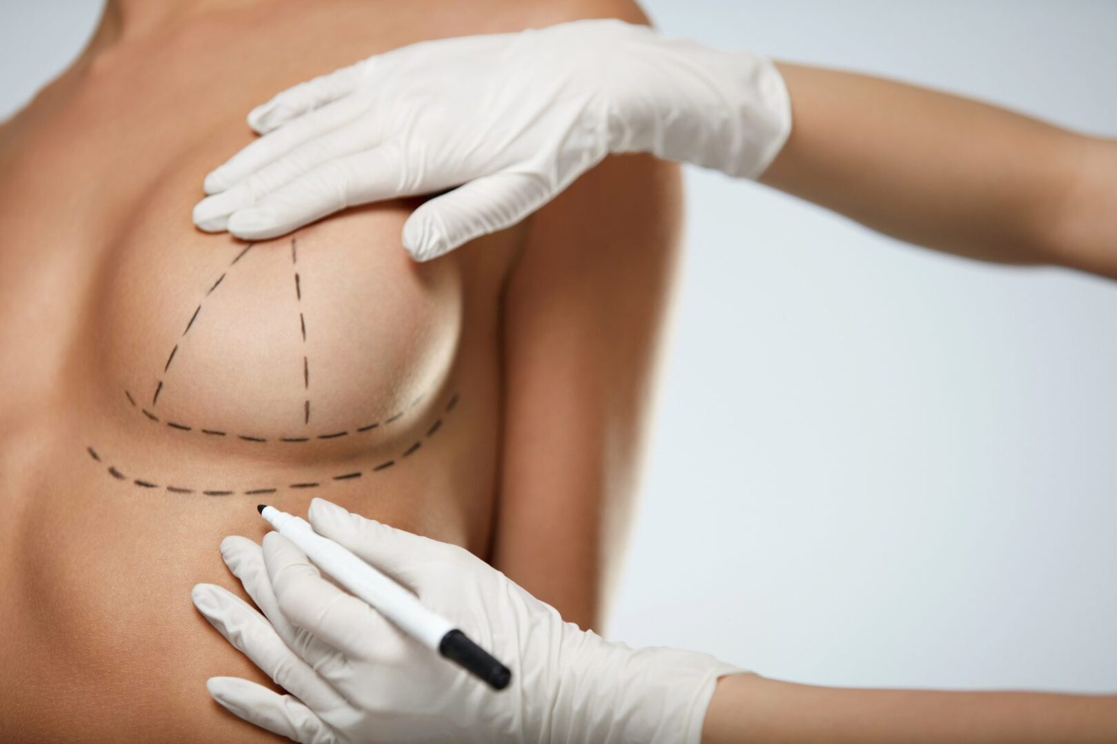 как делают пластическую операцию груди женщин фото 88