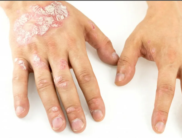 Подлежат ли мужчины с псориазом мобилизации