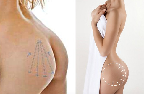 Пластика ягодиц: виды и особенности глютеопластики