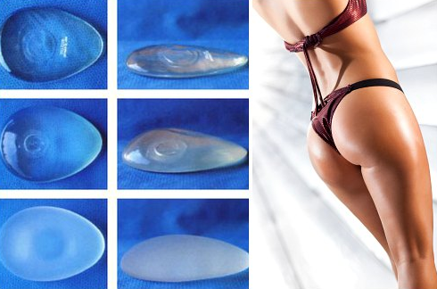 Пластика ягодиц: виды и особенности глютеопластики