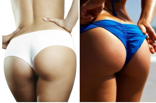 Пластика ягодиц: виды и особенности глютеопластики