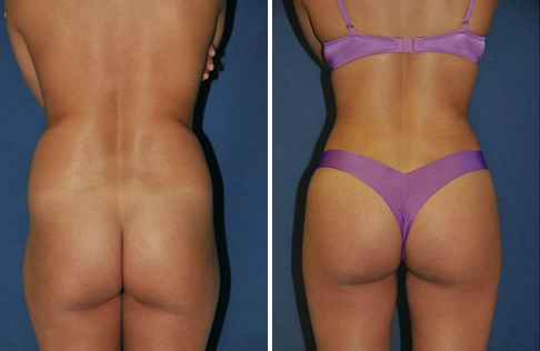 Пластика ягодиц: виды и особенности глютеопластики