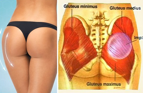 Пластика ягодиц: виды и особенности глютеопластики