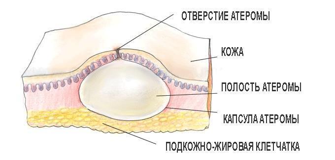 Атерома: причины, симптомы и лечение