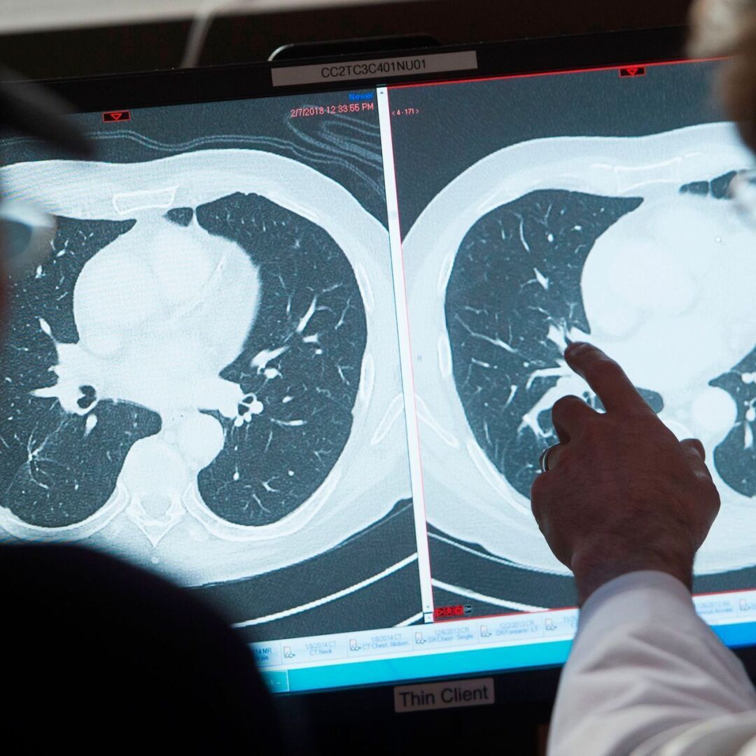 Уровень смертности от рака в США снизился на 30% с 1991 года