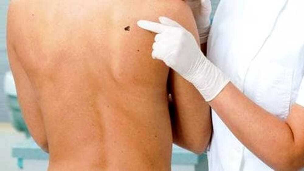 Как работает новая мРНК-вакцина против меланомы