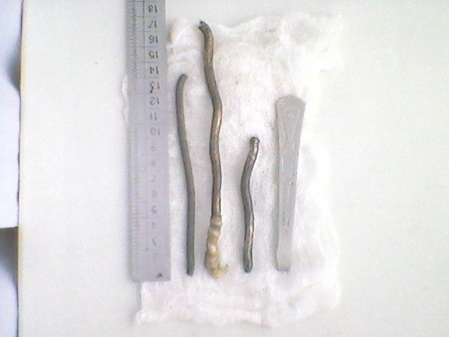 Вилка в желудке, пенопласт в ухе: вот так иногда заканчиваются новогодние посиделки