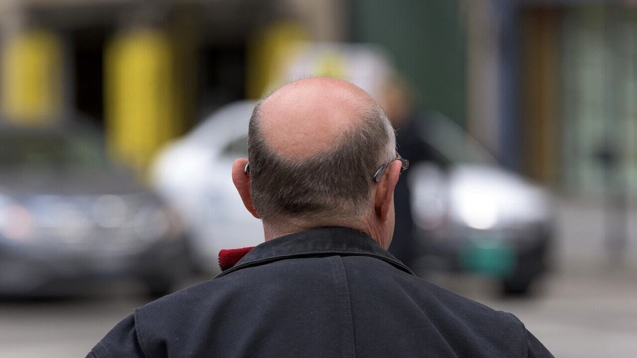 Алопеция, новые пластыри способствуют отрастанию волос: как они работают