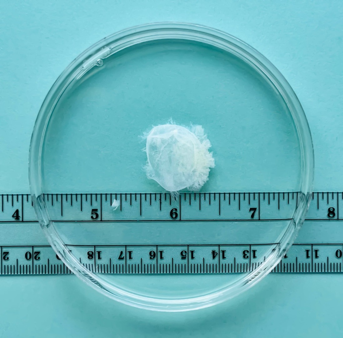 Ранний аборт совсем не похож на то, что вам рассказывали