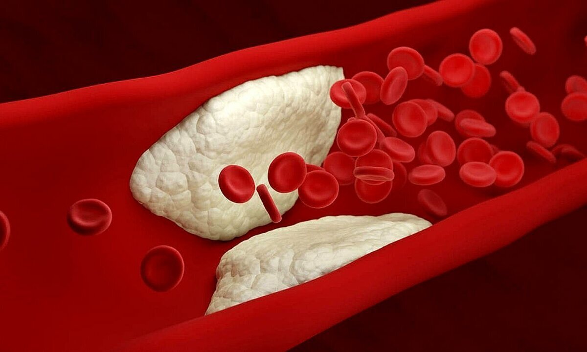Как очистить стенки артерий и снизить риск атеросклероза и сердечных заболеваний