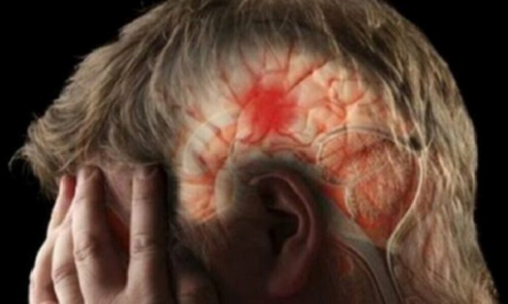 Как распознать инсульт