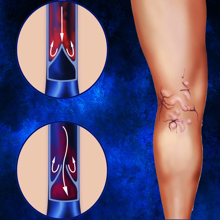 Варикоз. Как правильно и эффективно предотвратить варикозное расширение вен? Профилактика и лечение.