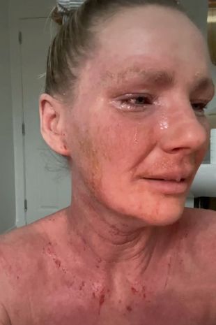 Женщина потеряла свою красоту, после того как крем от экземы "сжёг" её кожу по всему телу.