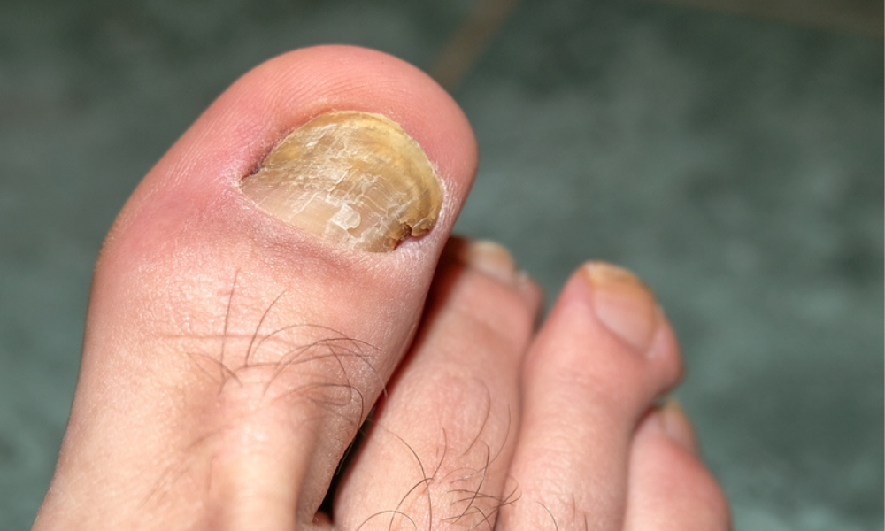 Грибок ногтей поражает кровь и запускает процесс некроза. Но есть решение для всех".