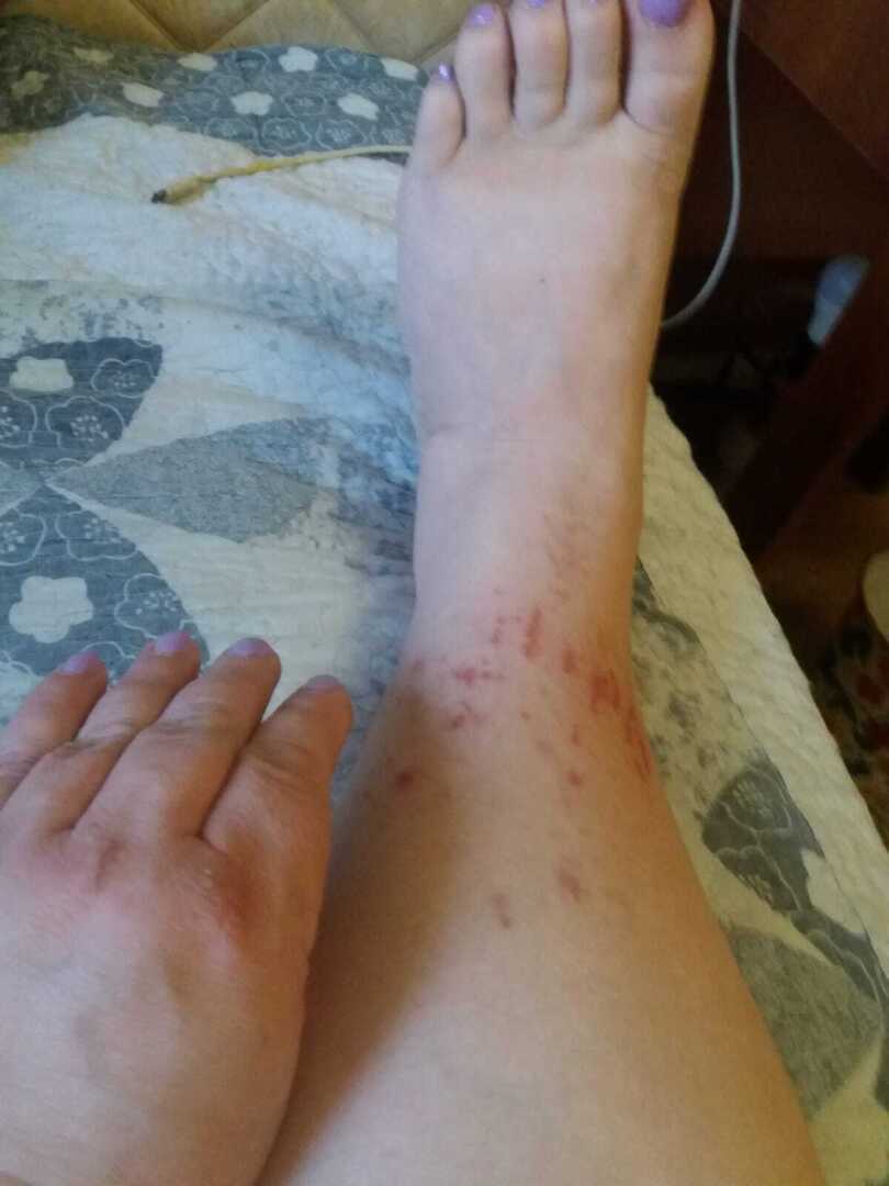 ПСОРИАЗ ,СРАВНЕНИЕ И РЕАЛЬНЫЕ РЕЗУЛЬТАТЫ отечественных, мазей и китайских .Хочу обратить внимание, что после 3х ковидных прививок ,...