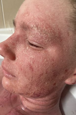 Женщина потеряла свою красоту, после того как крем от экземы "сжёг" её кожу по всему телу.