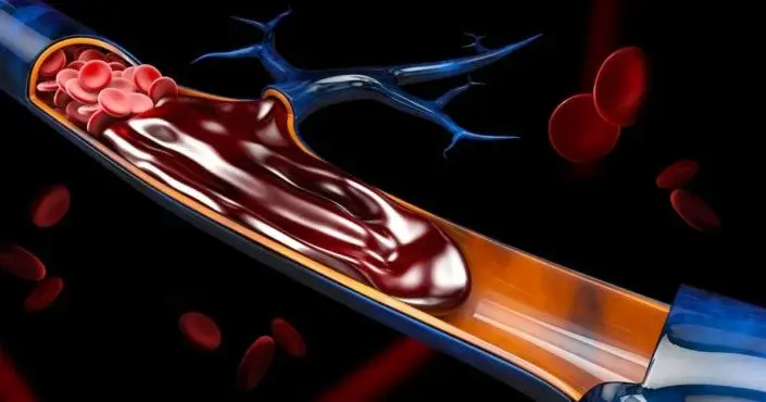 Сгустки крови