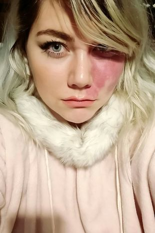 Мое родимое пятно не делает меня слишком уродливым для свиданий