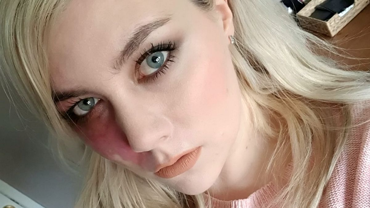 Мое родимое пятно не делает меня слишком уродливым для свиданий