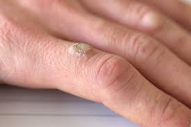 Удаление бородавок и папиллом.