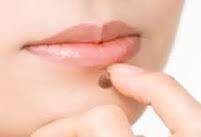 Удаление бородавок и папиллом.